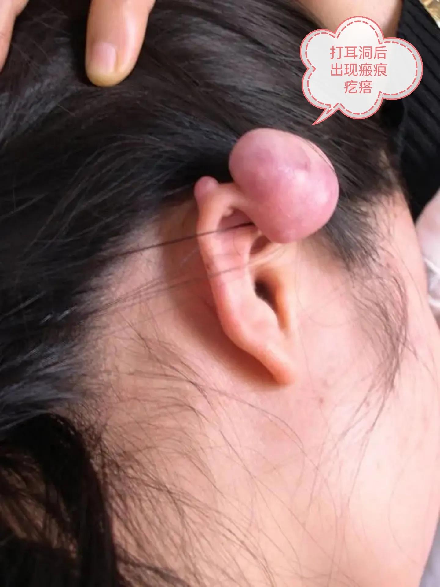 打耳洞引起的瘢痕疙瘩,打耳洞瘢痕疙瘩真实图片
