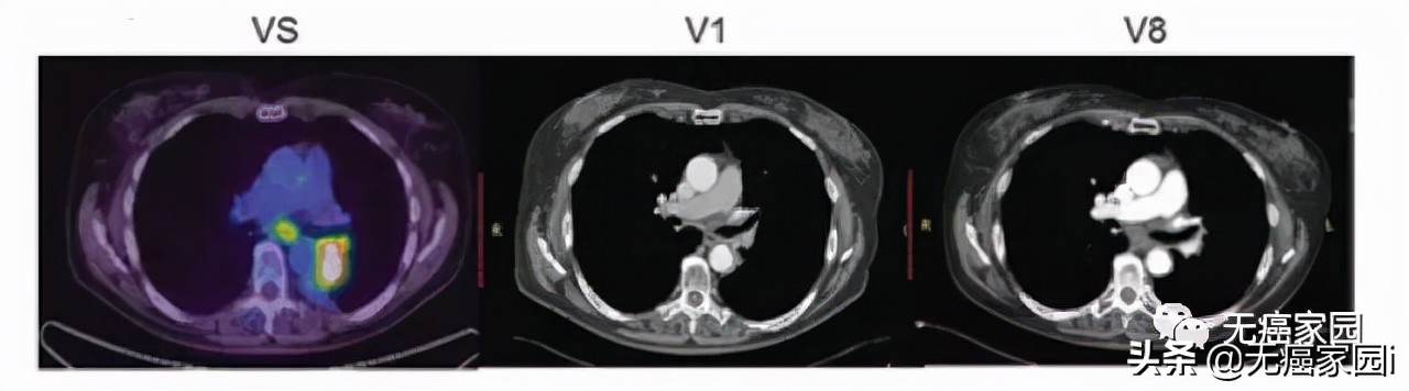 nk自然杀伤细胞治疗肿瘤效果,nk细胞治疗新突破
