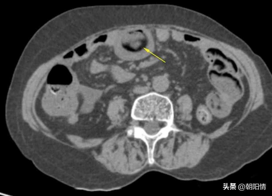 消化道异物中医诊断名称,消化道骨性异物