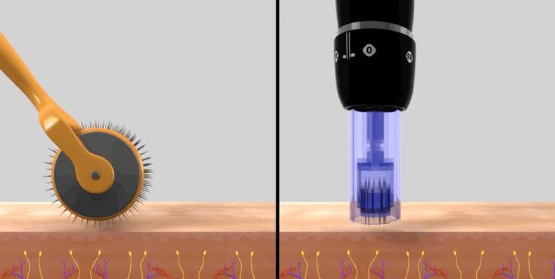 *疮痤**瘢痕的康复治疗