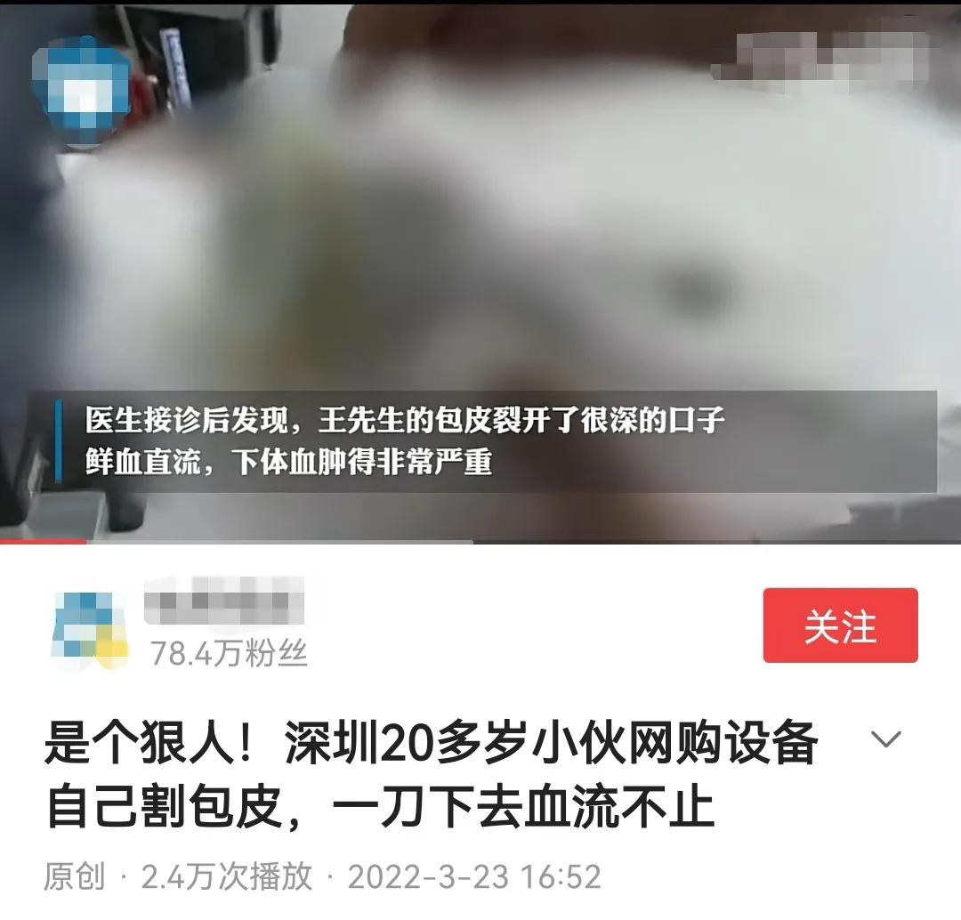 到底需不要割包皮,吻合器包皮环切术多少钱