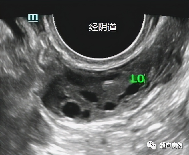 做阴道B超是一种什么样的体验？