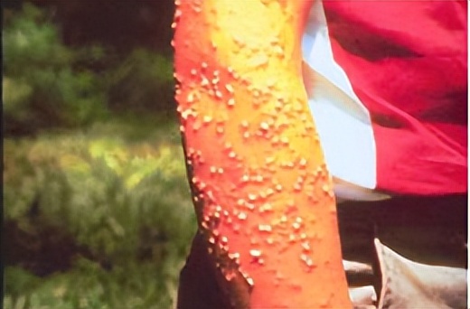 夏日带孩子户外活动当心这种虫,暑期带娃小心毒虫