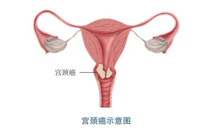 女性得宫颈癌的真实案例,女性宫颈癌的10大征兆