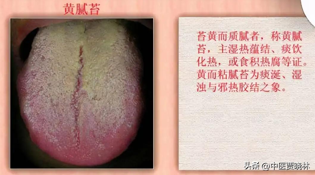 热咳痰黄色,风热咳黄痰吃什么药见效比较快