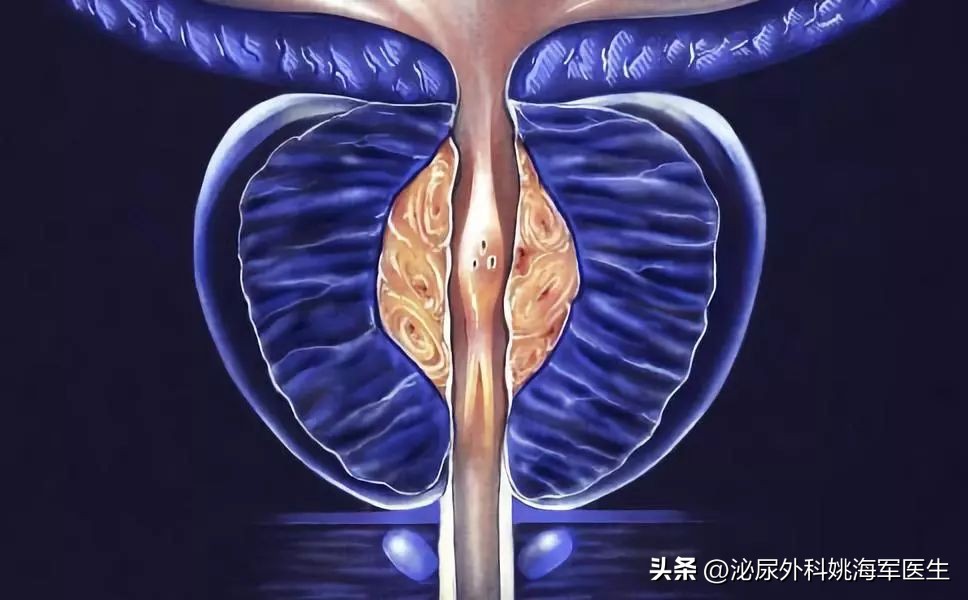 小谈前列腺炎你该知道的知识,了解治疗前列腺炎的误区有哪些