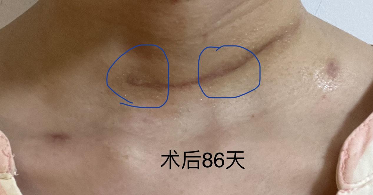 甲状腺癌手术全切疤痕多久能消除,甲状腺癌全切手术后的真实感受