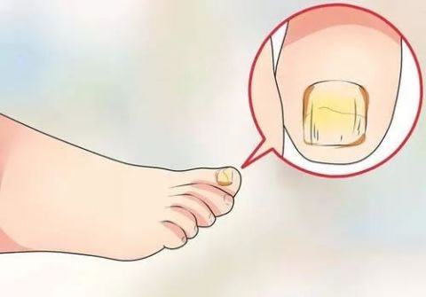 脚趾甲变厚变黄挂什么科,脚趾甲变厚到医院挂什么科