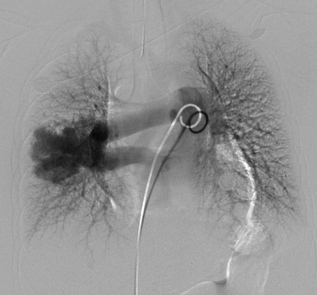 儿童遗传性毛细血管扩张会自愈么,遗传性出血性毛细血管扩张ct表现