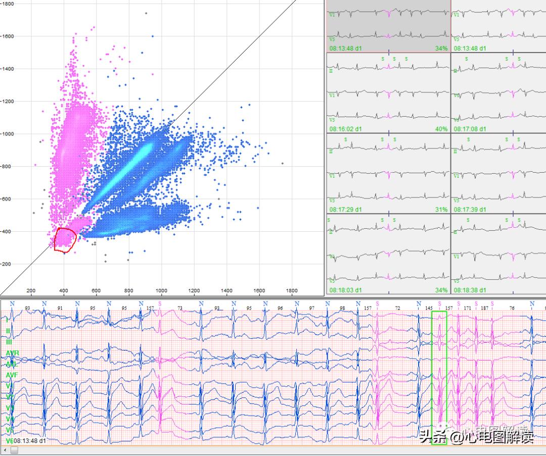 房早室早区别,房早室早房颤