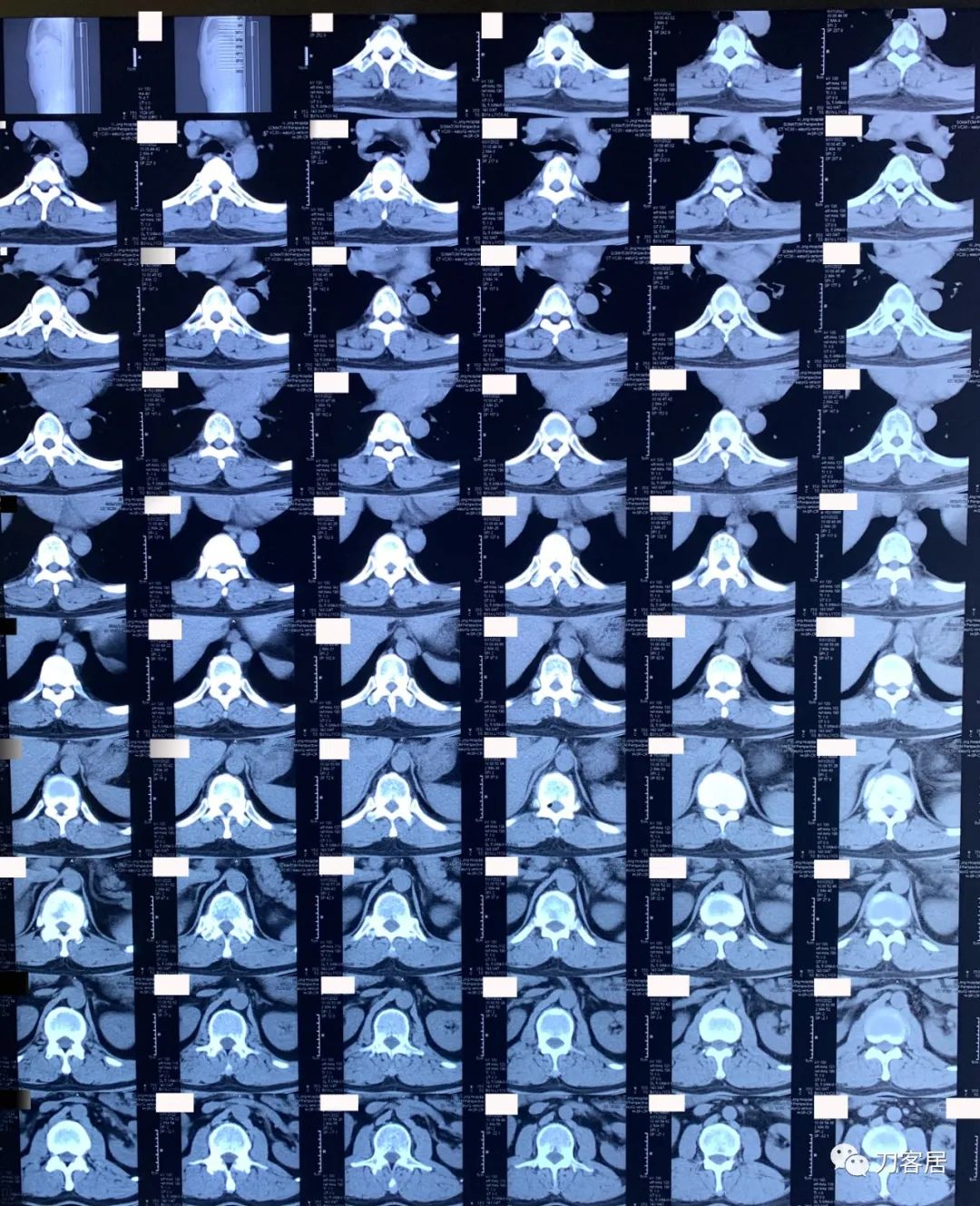 良性单侧下肢肌萎缩,下肢肌肉萎缩24年能治好吗