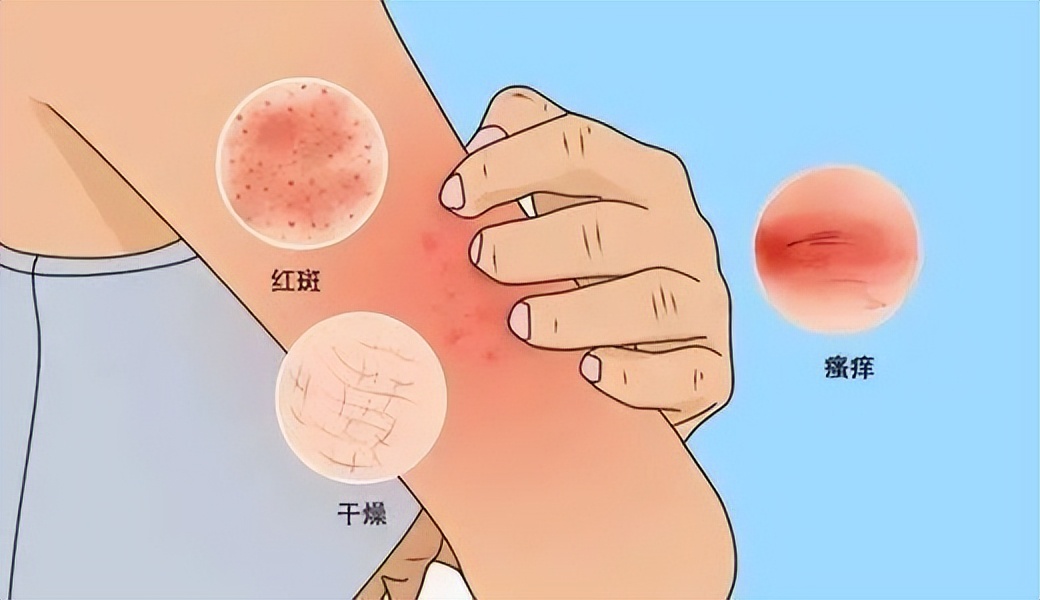 红霉素软膏祛老年斑小妙招,红霉素软膏原来是老年斑克星