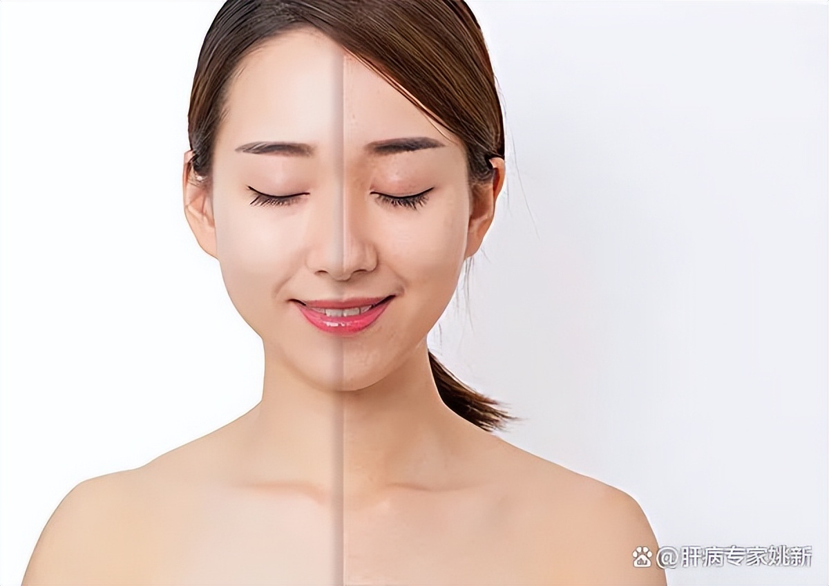 肝硬化病人护理措施,肝硬化日常护理怎么做