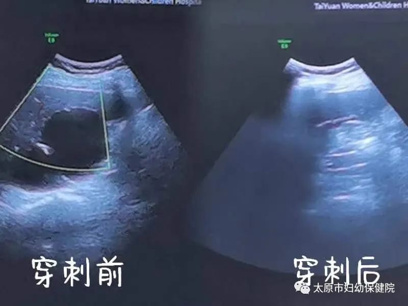 肝囊肿穿刺诊断及介入治疗的方法,超声引导下肝结节穿刺活检