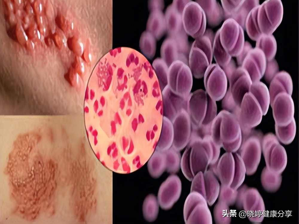 淋病引起的并发症,淋病的危害及并发症