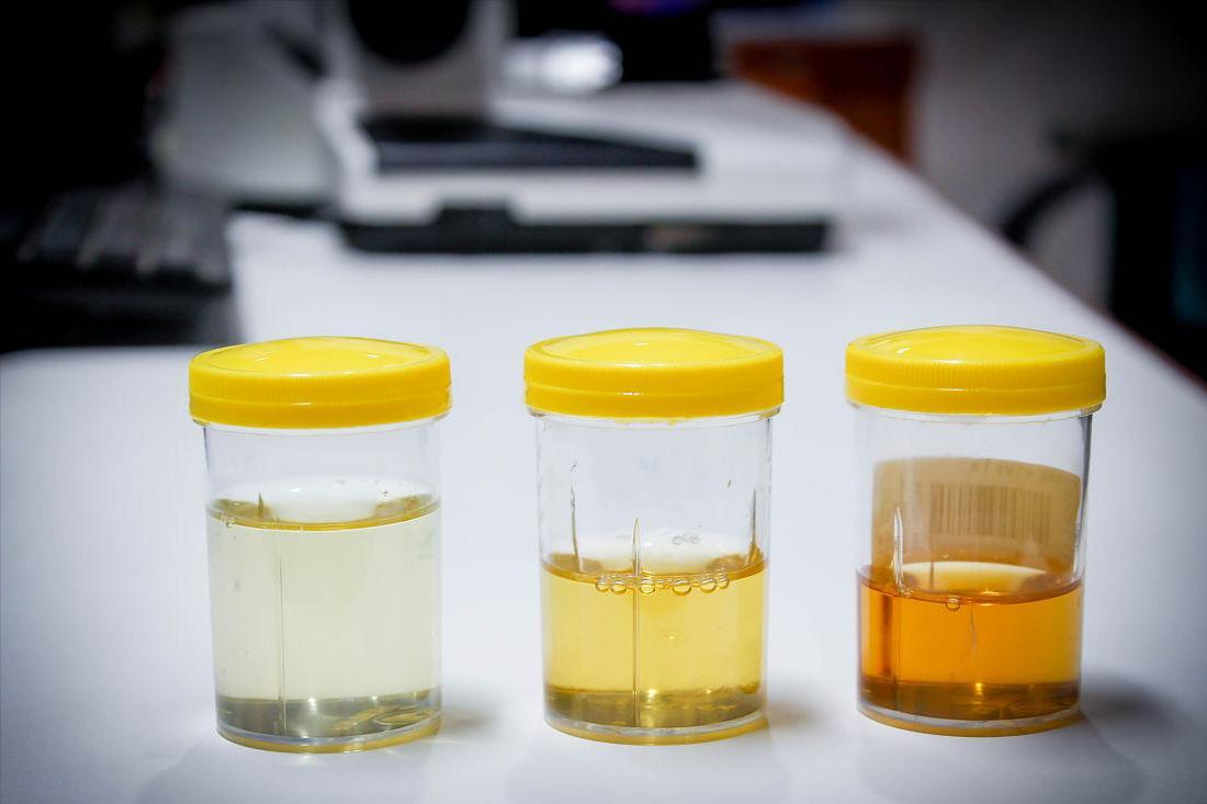 糖尿病肾病气阴两虚型食疗药膳,糖尿病肾病引起腹泻用什么中成药