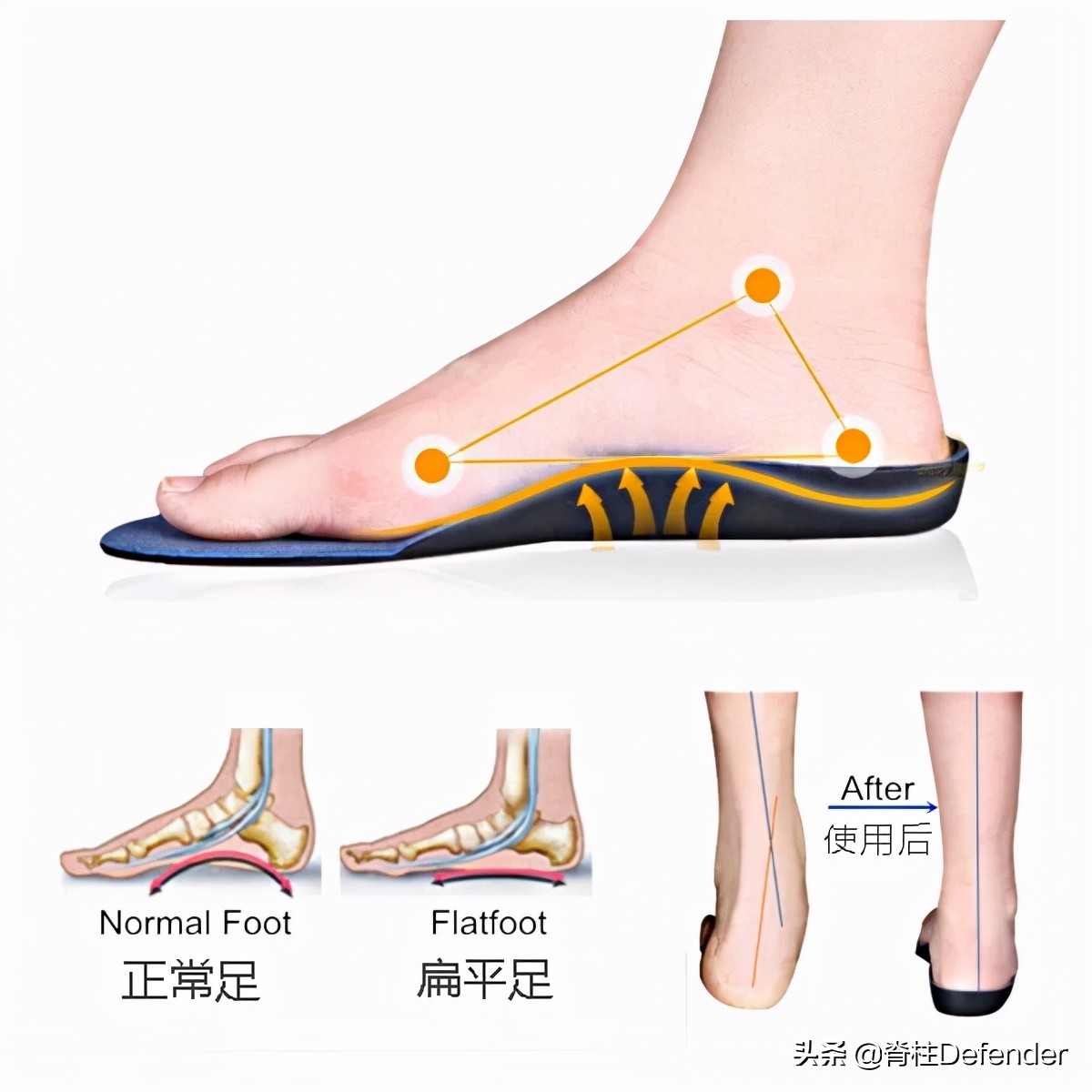 足跟痛筋膜炎最佳的治疗方法,足跟痛和足底筋膜炎康复治疗