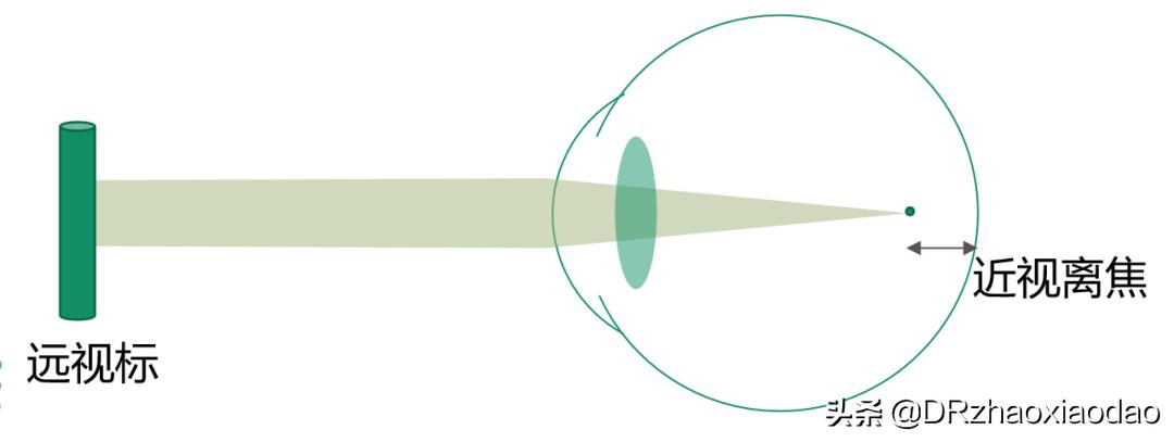 雾视治疗的最佳方法,雾视治疗是什么意思