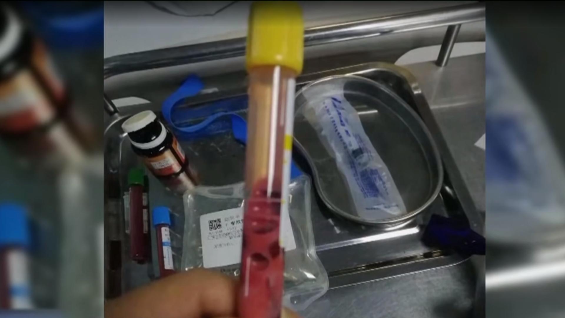 20岁女孩查出糖尿病,杭州17岁少女得了糖尿病