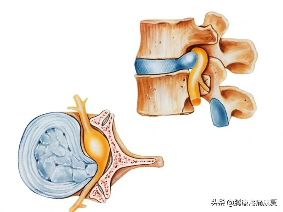 腰5骶1椎间盘突出可以跑步锻炼吗,腰4-5椎间盘突出手术需要多少钱