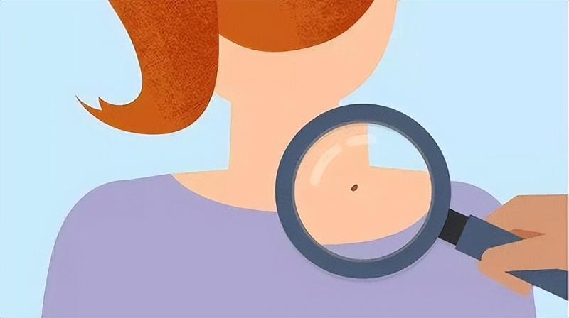 痣可以随便取吗,脸上的痣能随便取吗