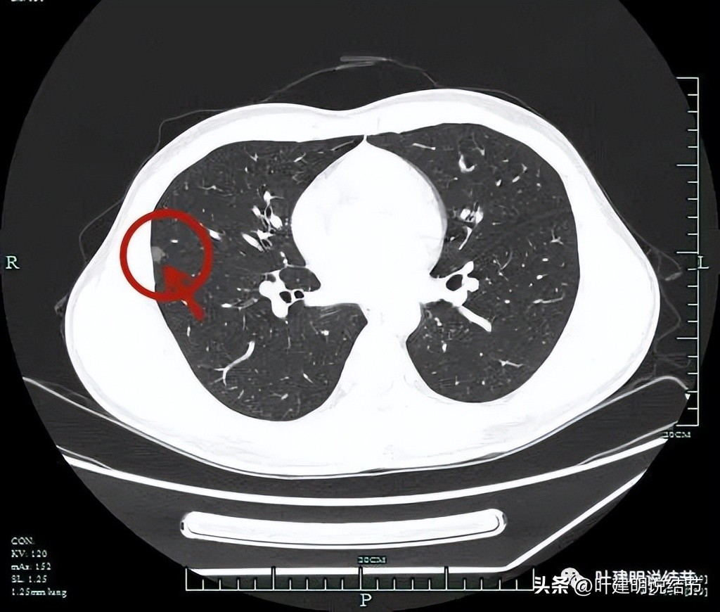 中叶多发微小结节,男性30岁右侧甲状腺单发结节