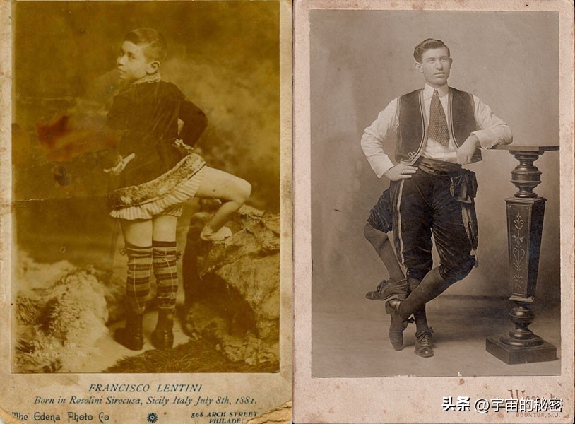 这个美国人有三条腿4只脚2个把！但他还结了婚有了4个孩子