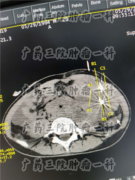 直肠腺癌lla手术能治愈吗,直肠腺癌手术是大手术吗
