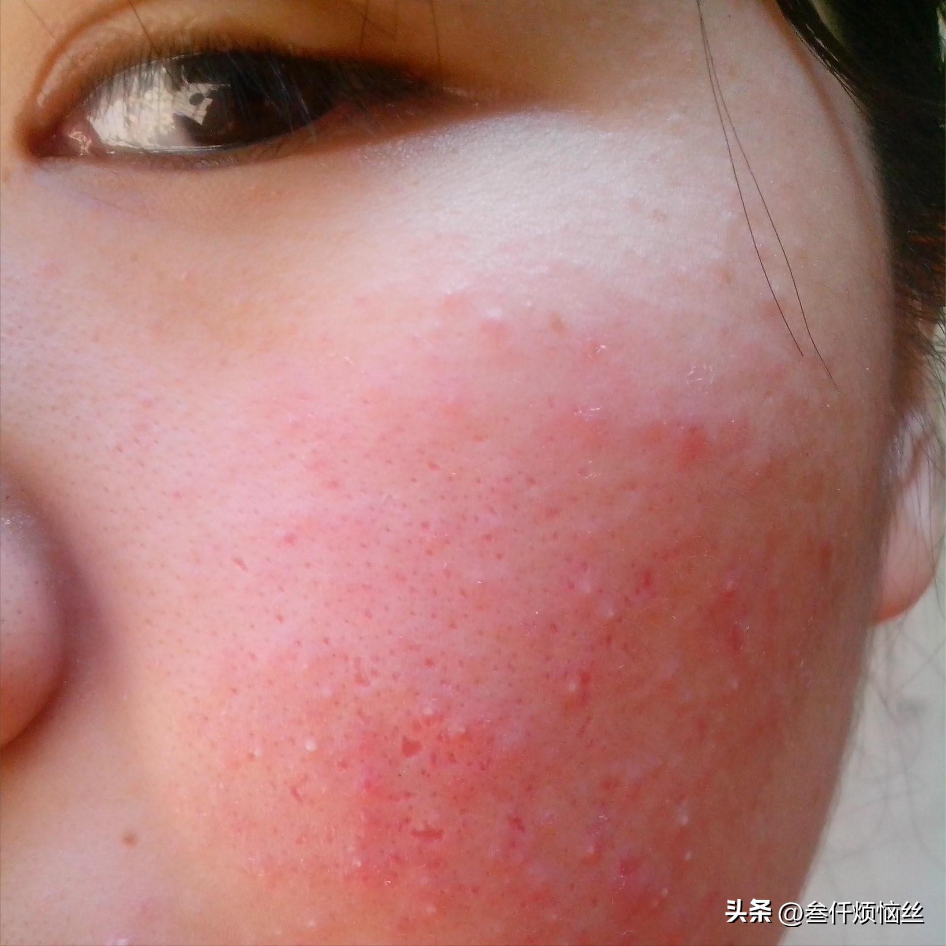 头发过敏用什么染发剂,染发剂过敏的一个现象