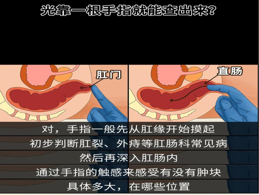 别尴尬！“一阳指”是项正经且重要的检查，作用不可小觑
