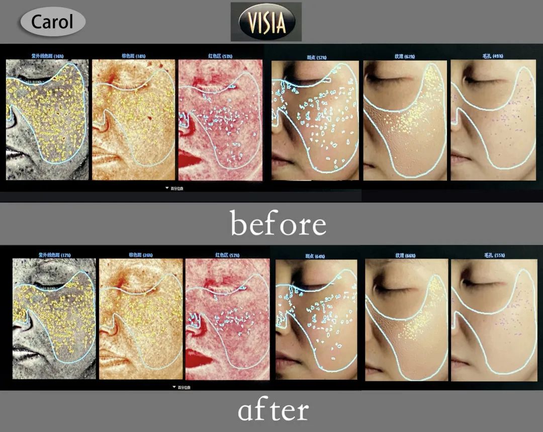 美肌试颜室‖直播见证，4周院线护肤的逆袭之路