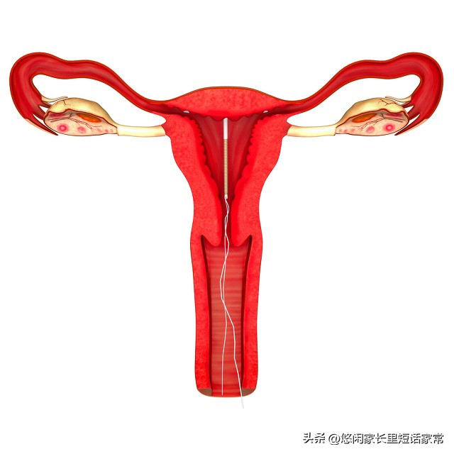 闭经后，节育环，是取还是留？