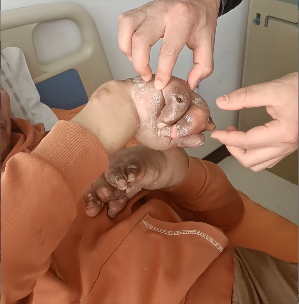 张仲景的痛风方子,张仲景治痛风是真的吗