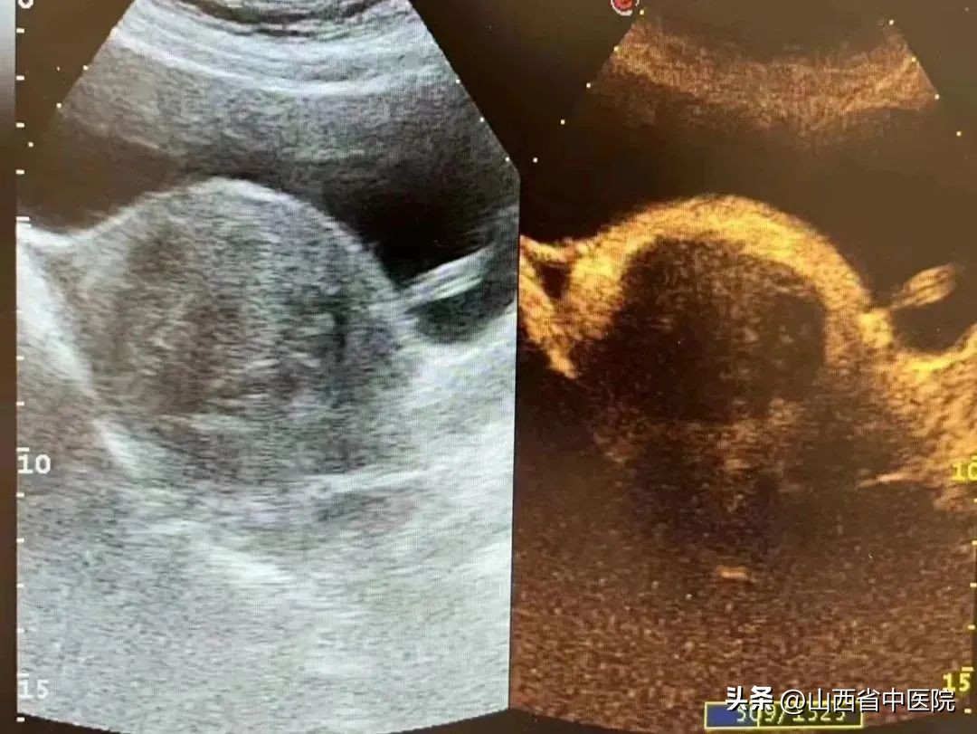 山西有介入手术治疗子宫肌瘤的么,不开刀去除子宫瘤