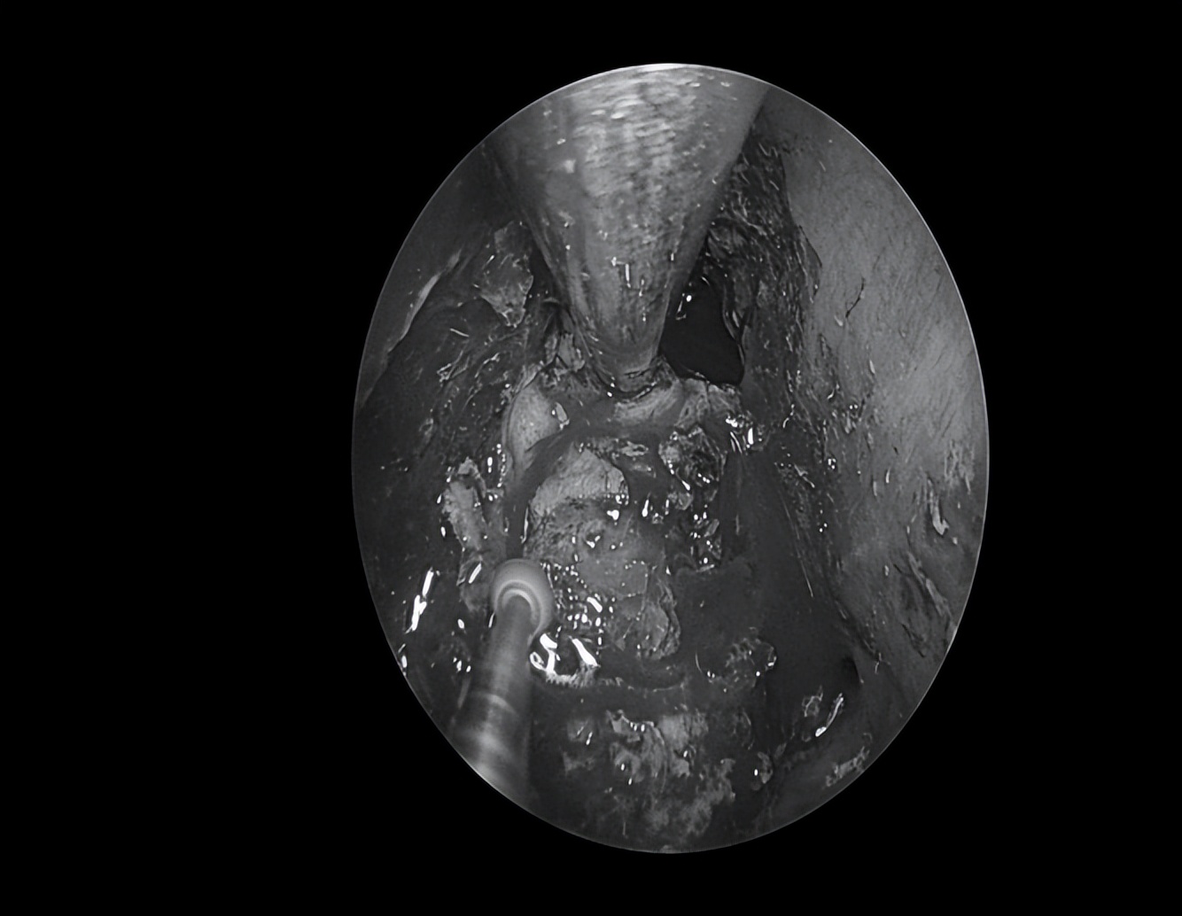 南昌二附院耳鼻喉科手术,南昌大学第二附属医院耳鼻咽喉科