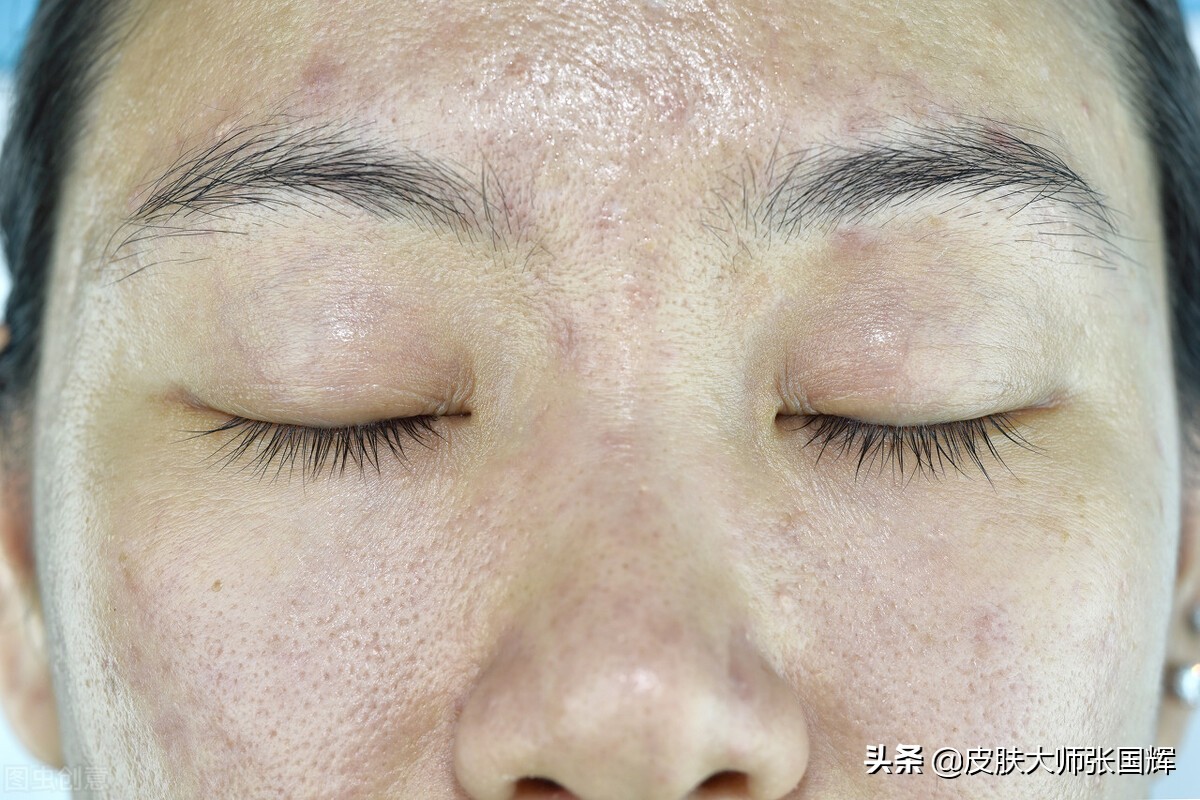 毛孔粗大的原因和治疗方法,毛孔粗大原因及改善方法