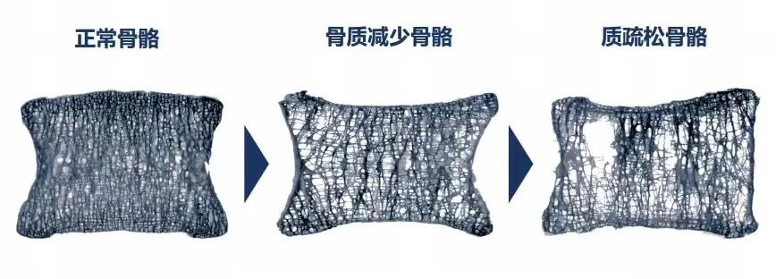 中年妇女手指腱鞘炎是怎么回事,更年期脚拇指腱鞘炎