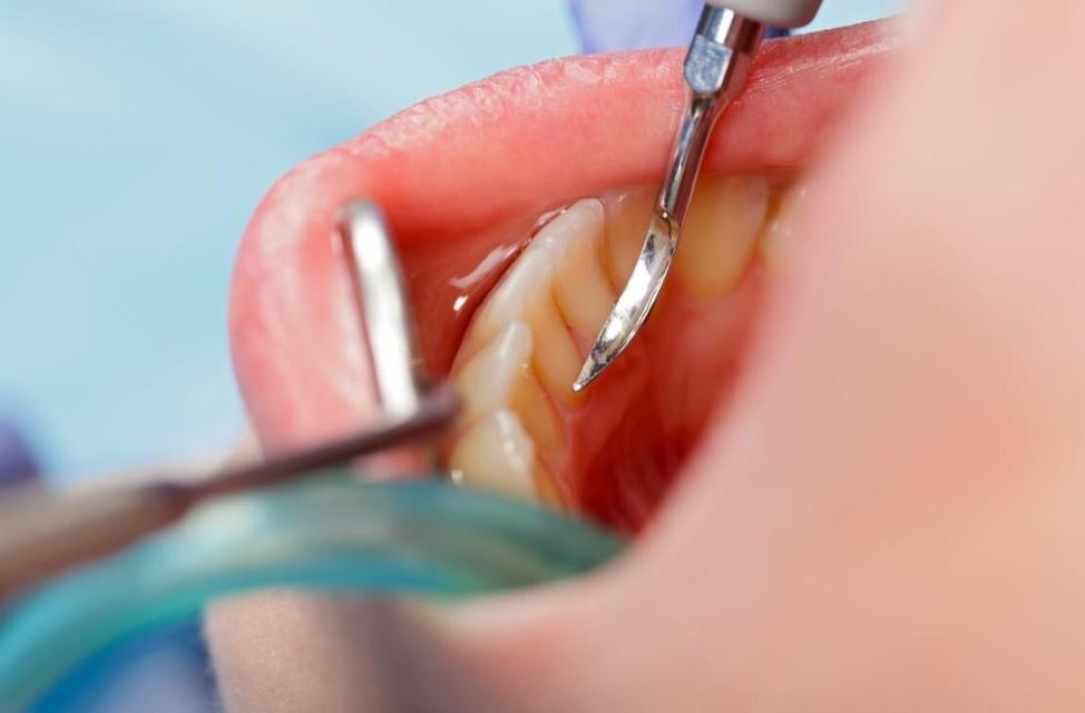 牙缝有牙结石怎么去除,牙缝间的牙结石怎么清除