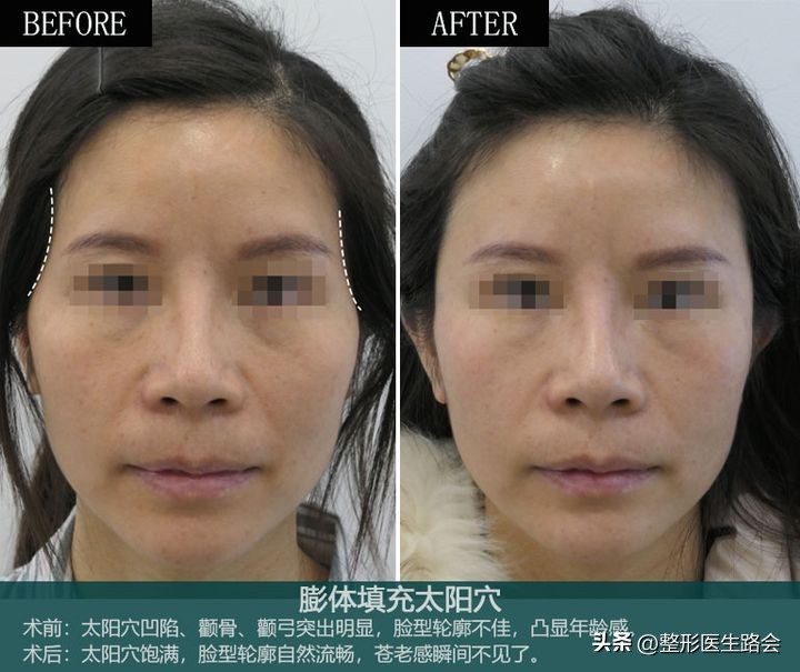 太阳穴做了填充手术第7天,填充太阳穴手术经历