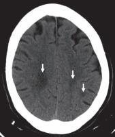 脑水肿的影像,脑水肿形成机制生理学