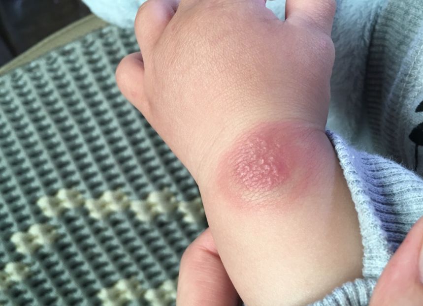 宝宝被蚊子咬后留疤怎么消除,宝宝被蚊子咬了疤痕变红怎么去除