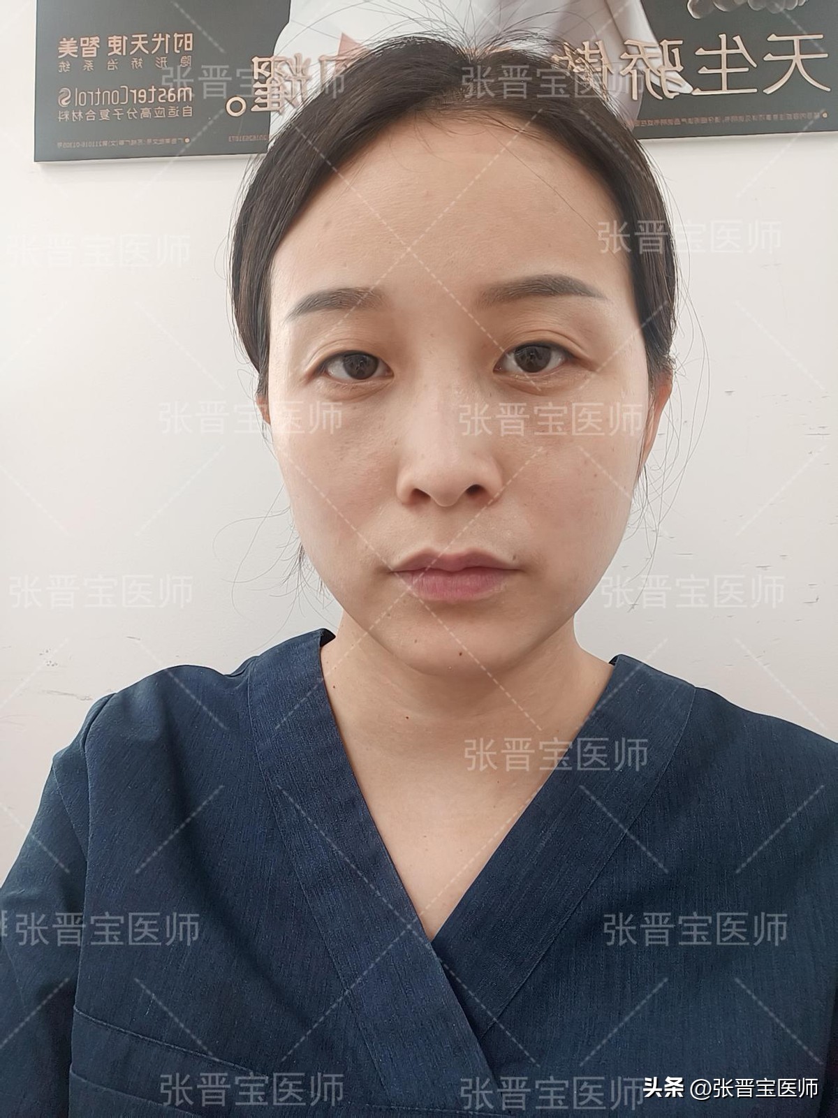 去眼袋手术后期变老,去眼袋手术的真实感受