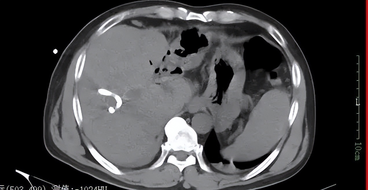 肝内胆管结石微创取石恢复快吗,一男子从胆囊取出几百个结石
