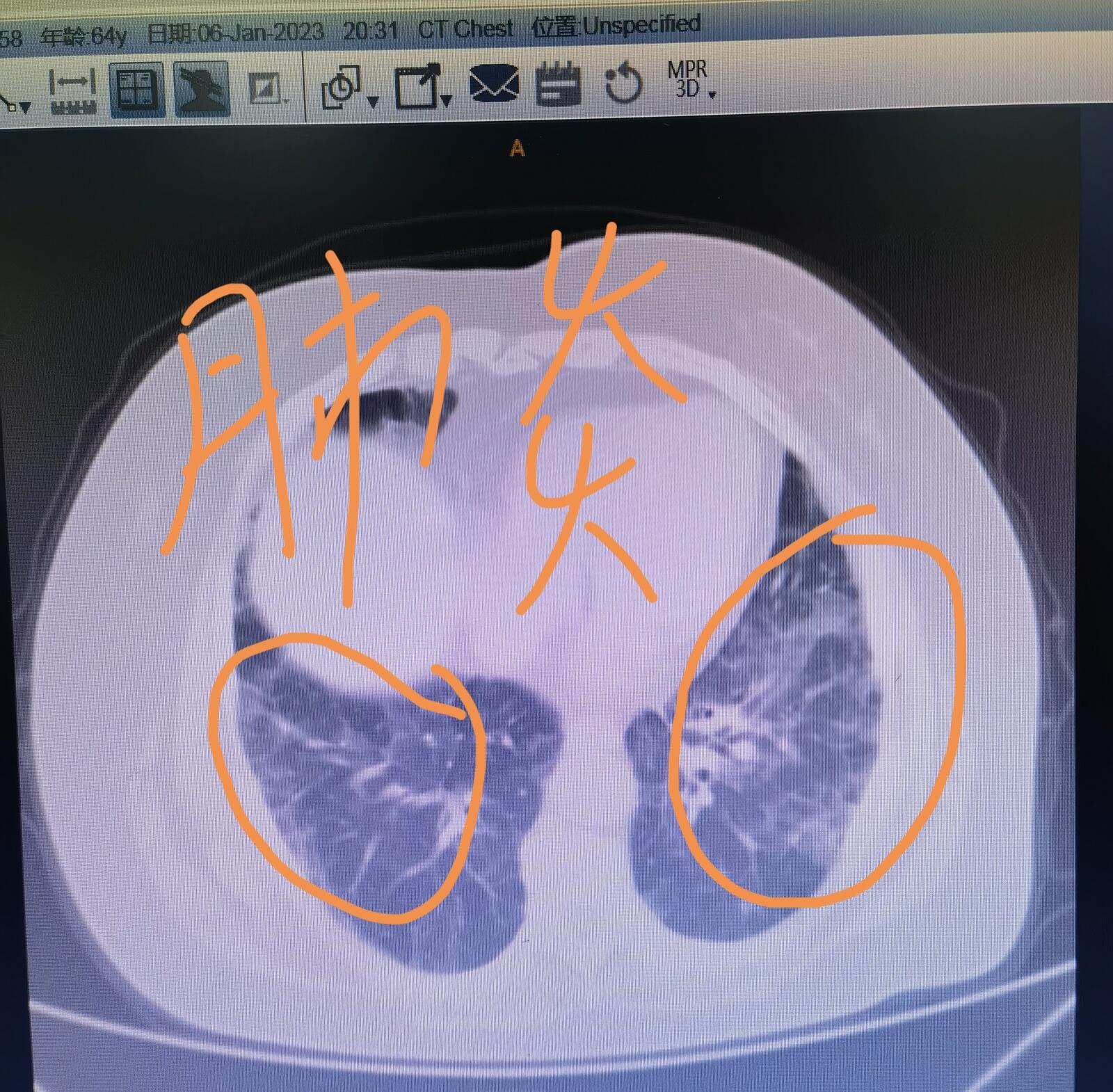 刘懿说肺癌排查结核,刘懿博士说肺癌的症状