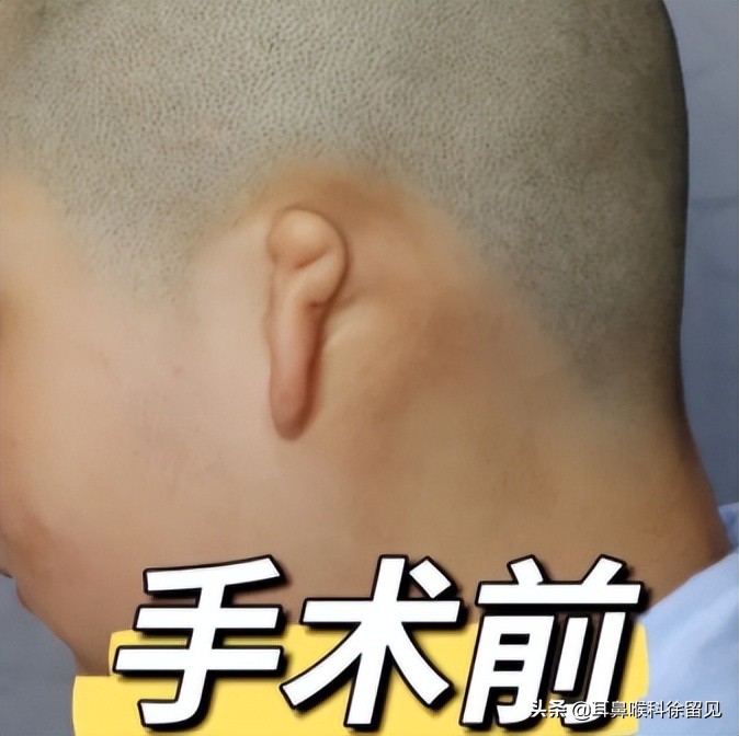 小孩先天无耳朵,小孩生下来没耳朵怎么治疗