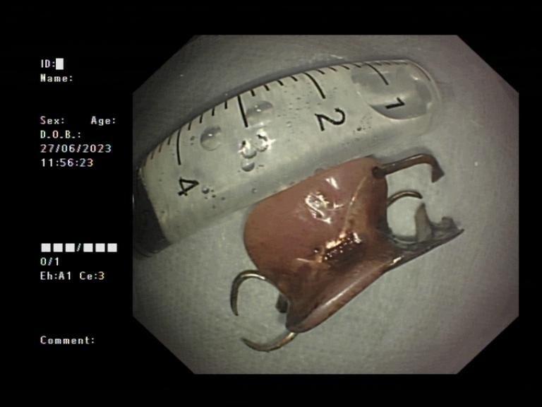 89岁老人吃饭突然不“香”了，原来是假牙吞进肚子里