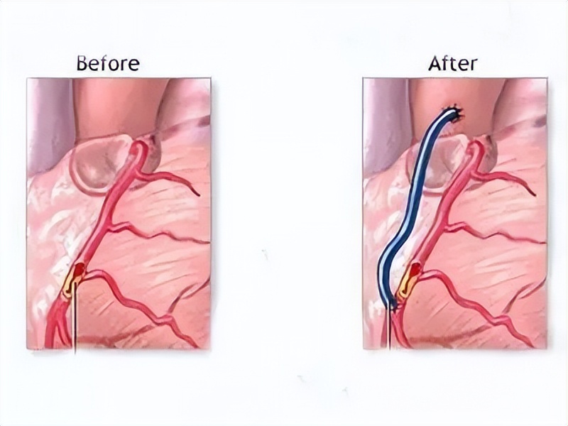 鑵跨棝瀵艰嚧鎴偄,鑵跨棝鎴偄