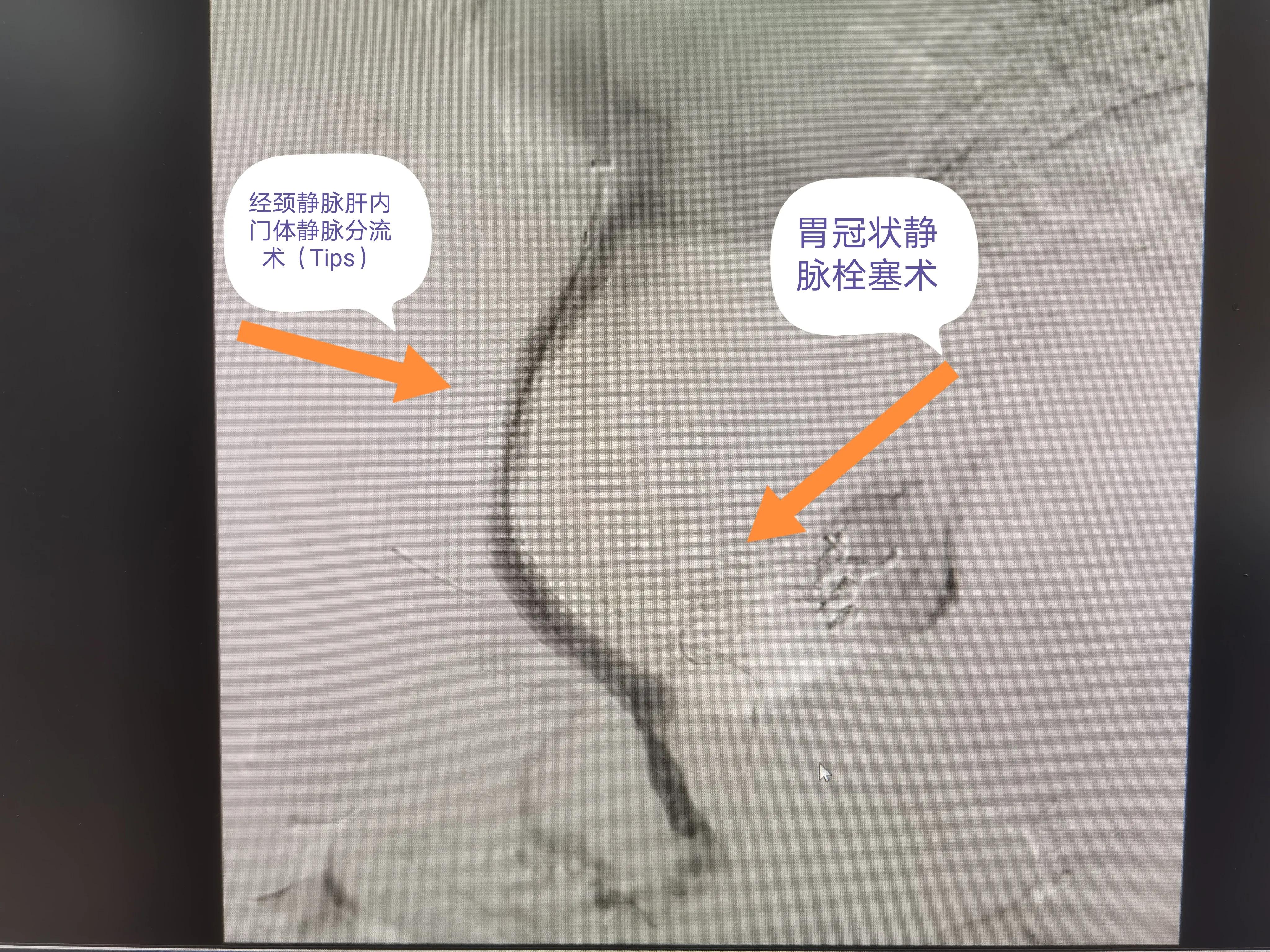 肝癌晚期伴胃溃疡出血,肝癌晚期合并脑卒中