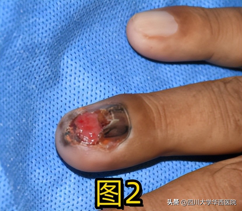 华西专家说，不是转你们，起码有一半的人从没有剪对过指甲儿！