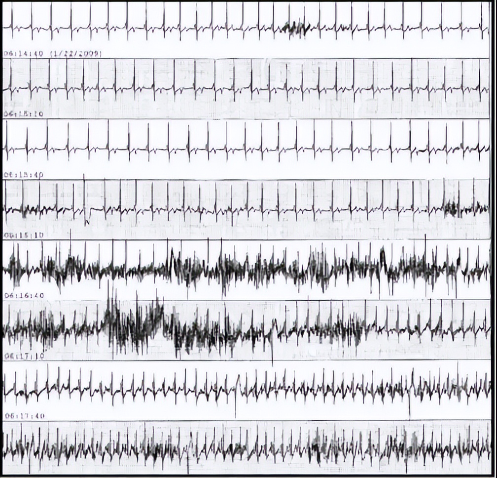 心电图机干扰信号过大的原因,心电伪差一般是指哪些干扰